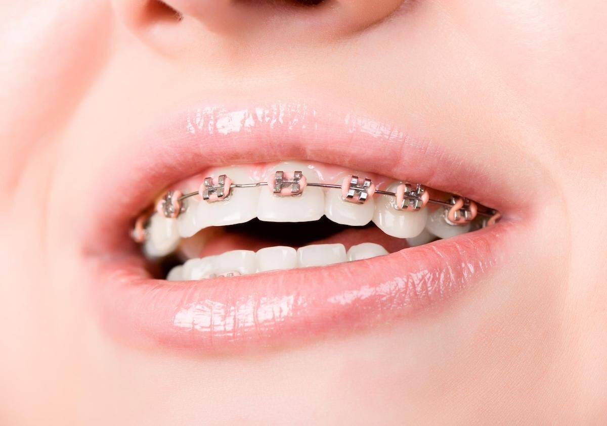 Children’s Orthodontist Hawthorn for Early Smile Assessment